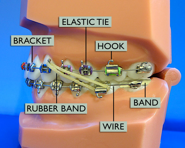 Proses Braces : The Pain - Kesakitan yang Dialami ketika pakai Braces - Blog4u