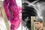 Lelaki batuk tak berhenti, Doktor cek ada pokok dalam paru-paru rupanya macam ini cara pokok tumbuh