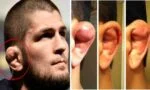 Kenapa telinga 'bengkak' ini selalu terjadi kepada 'fighter', ini puncanya
