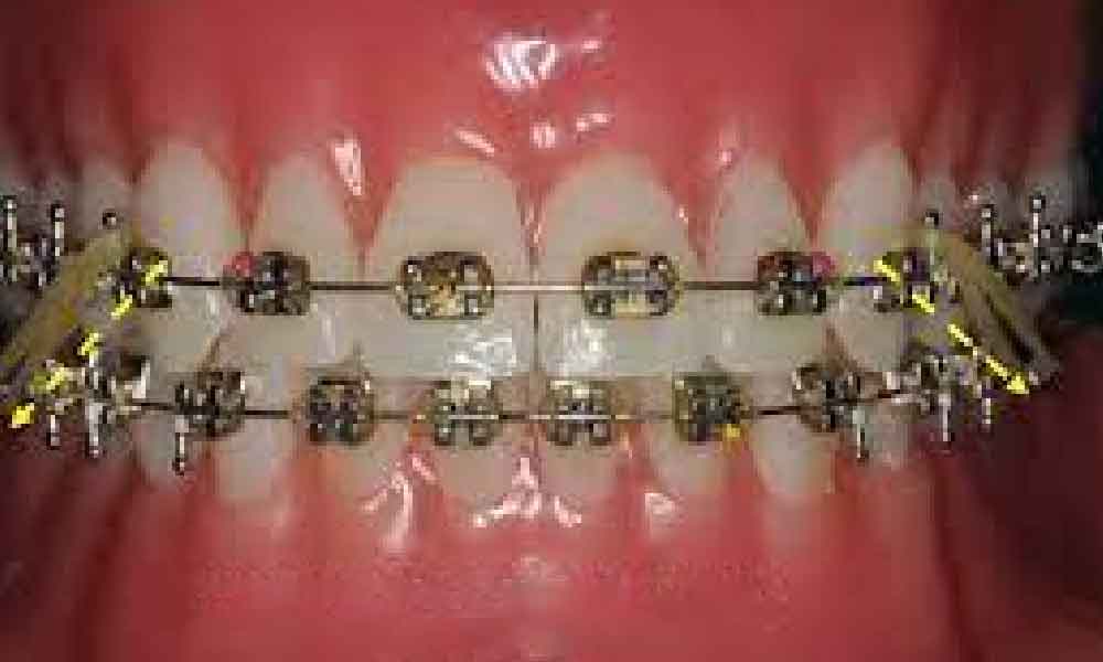 Ramai tertanya-tanya macam mana proses braces susun gigi berterabur ramai nak tahu